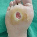 Neuropathic ulcer on the bottom of the foot