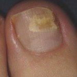 fungal toenail